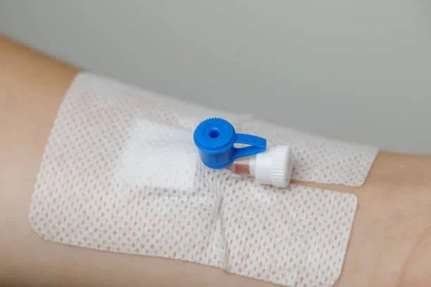 An example of a cannula secured to an adult hand.